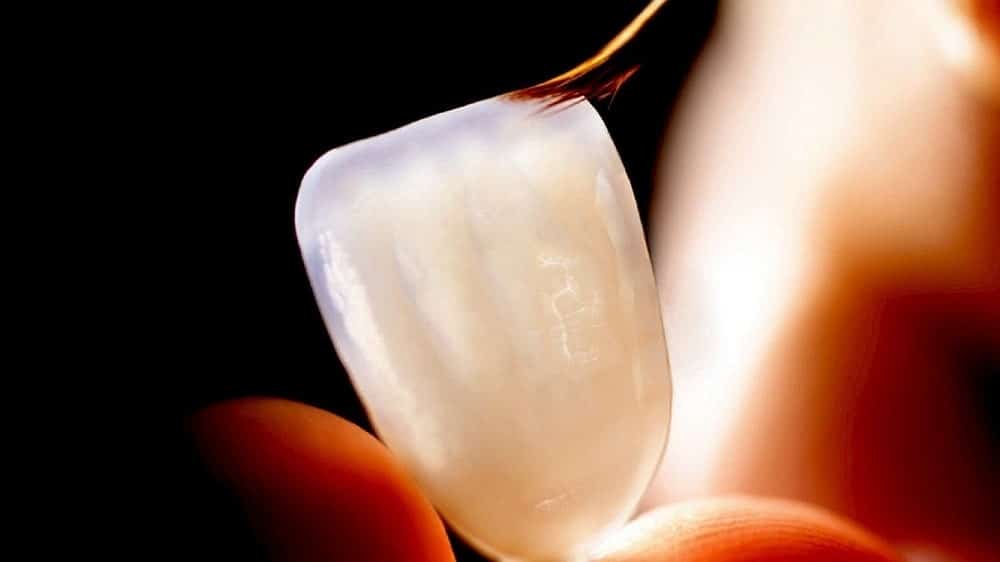 نکات مراقبتی برای افزایش عمر لمینت دندان