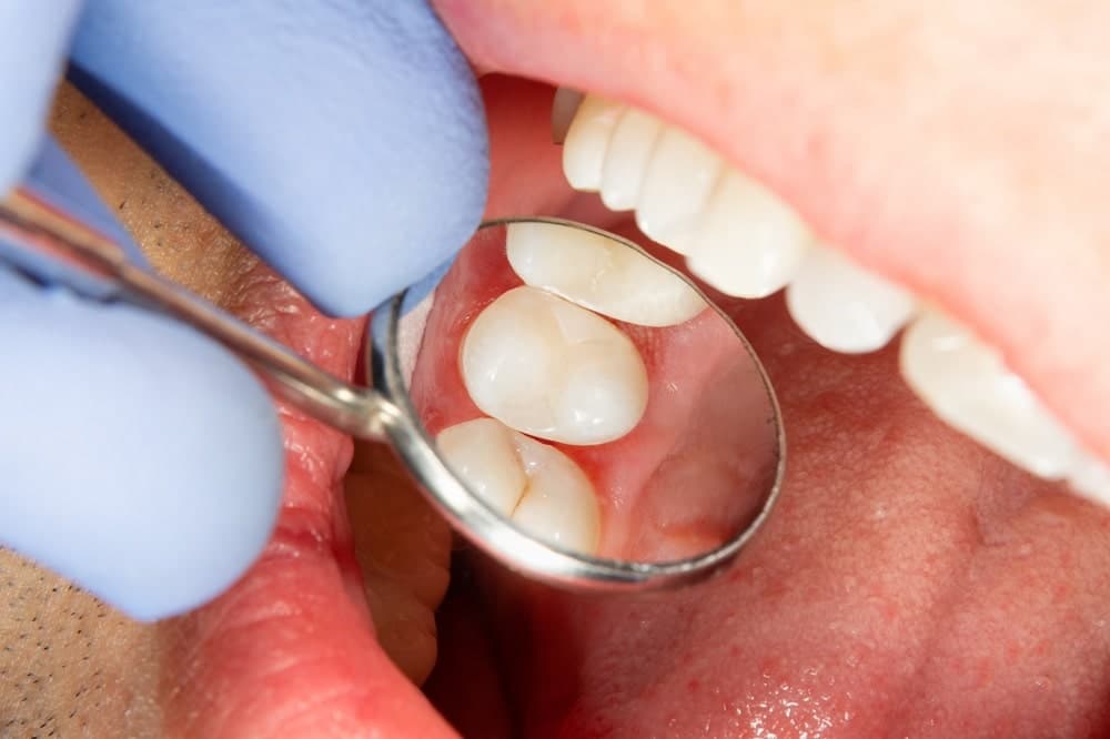 چرا از کامپوزیت دندان استفاده می‌کنیم؟