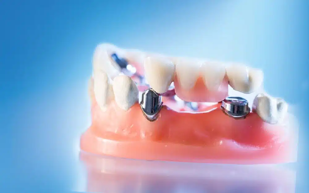 ایمکس دندان چیست؟