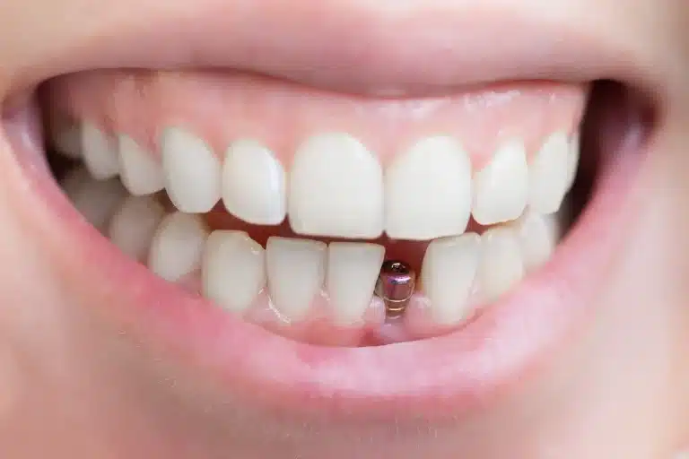 ایمپلنت دندان جلو