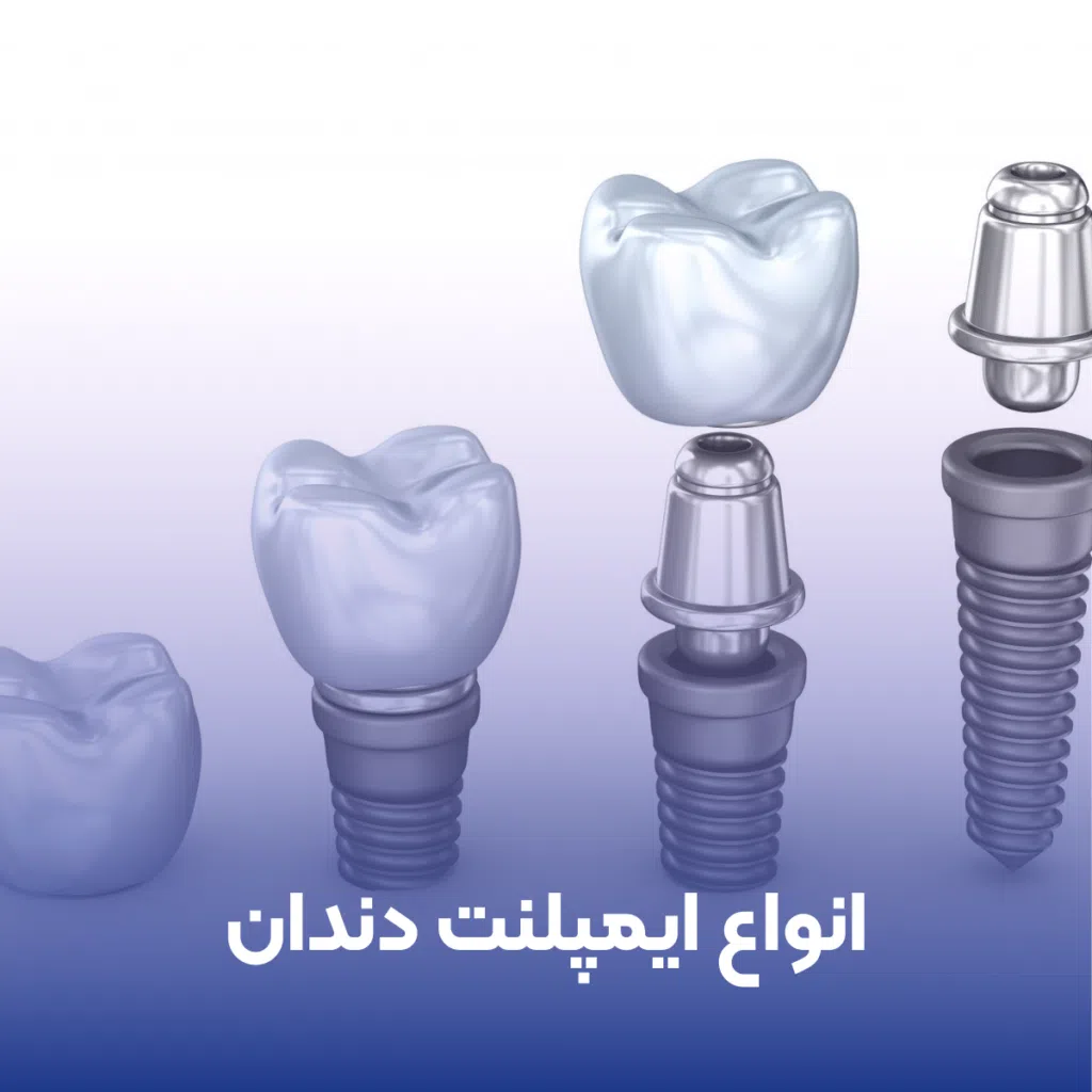 انواع ایمپلنت دندان - دکتر فرزانه فرخ نژاد دکترای دندانپزشکی