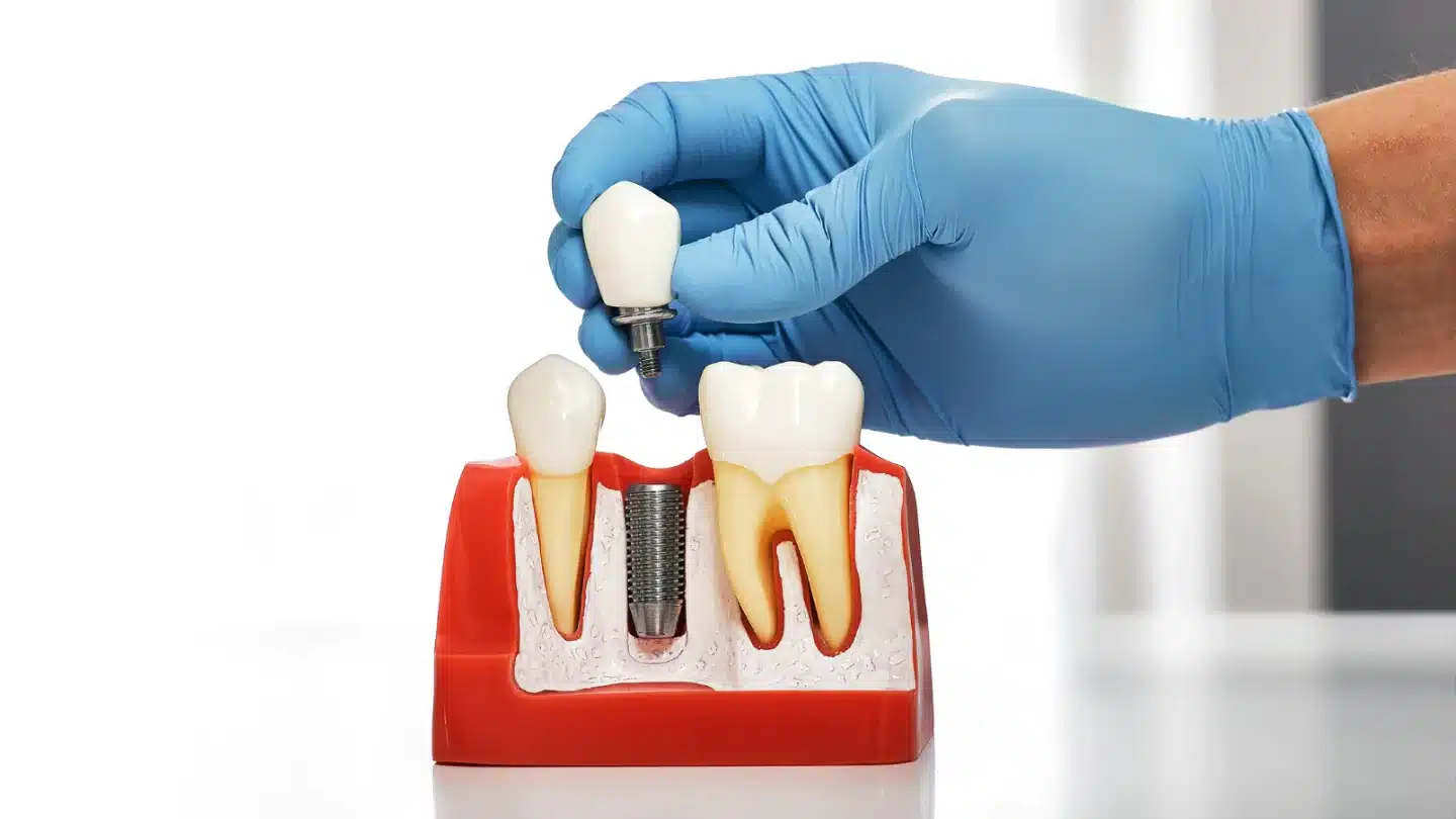 قرار دادن تاج دندان در ایمپلنت