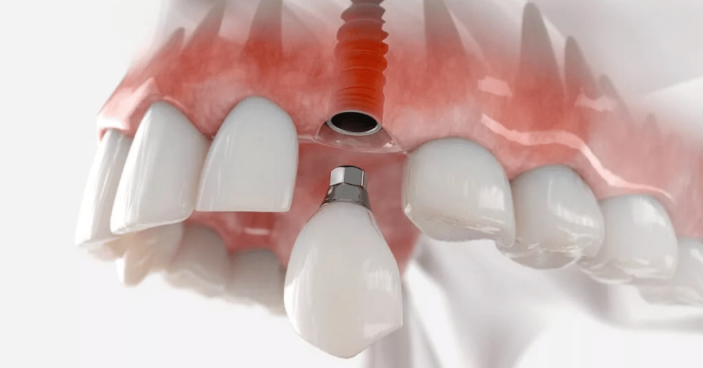 آیا حرف زدن بعد از ایمپلنت سخت خواهد بود؟