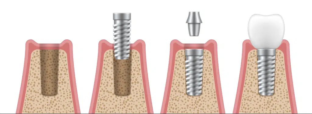 0 تا 100 مراحل ایمپلنت دندان در دندانپزشکی - دکتر فرزانه فرخ نژاد دکترای دندانپزشکی