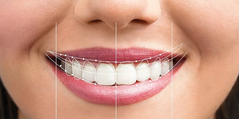 چگونگی اصلاح طرح لبخند با کامپوزیت دندان - دکتر فرزانه فرخ نژاد دکترای دندانپزشکی