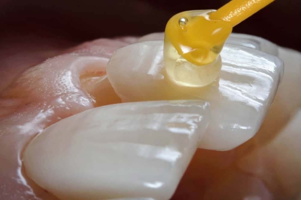 لمینیت دندان 15 مراحل لمینت دندان