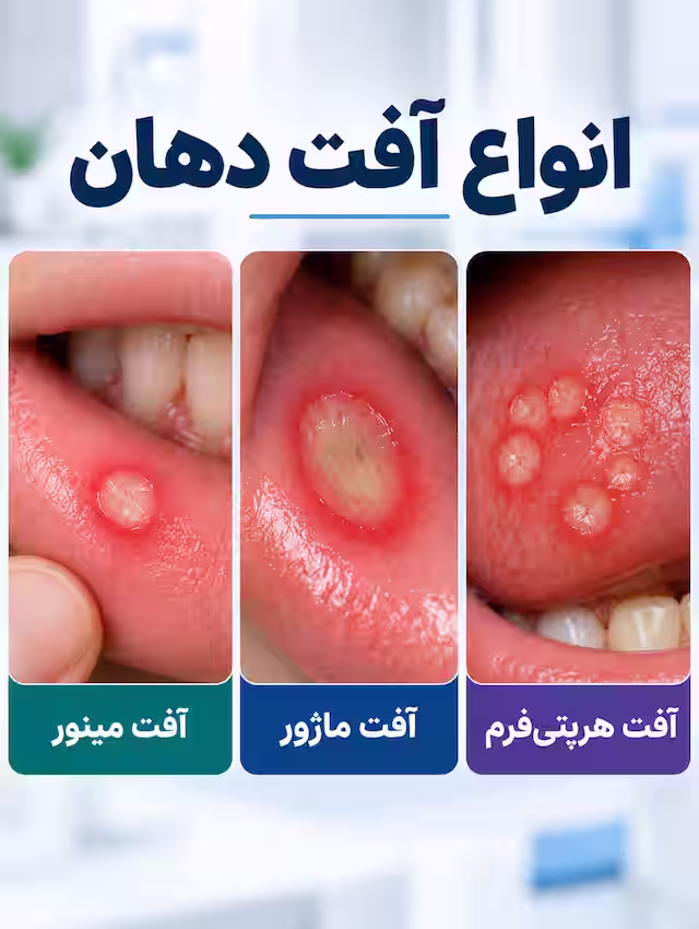 انواع آفت دهان از نظر شکل و شدت؛ آفت مینور، ماژور و هرپتی‌فرم