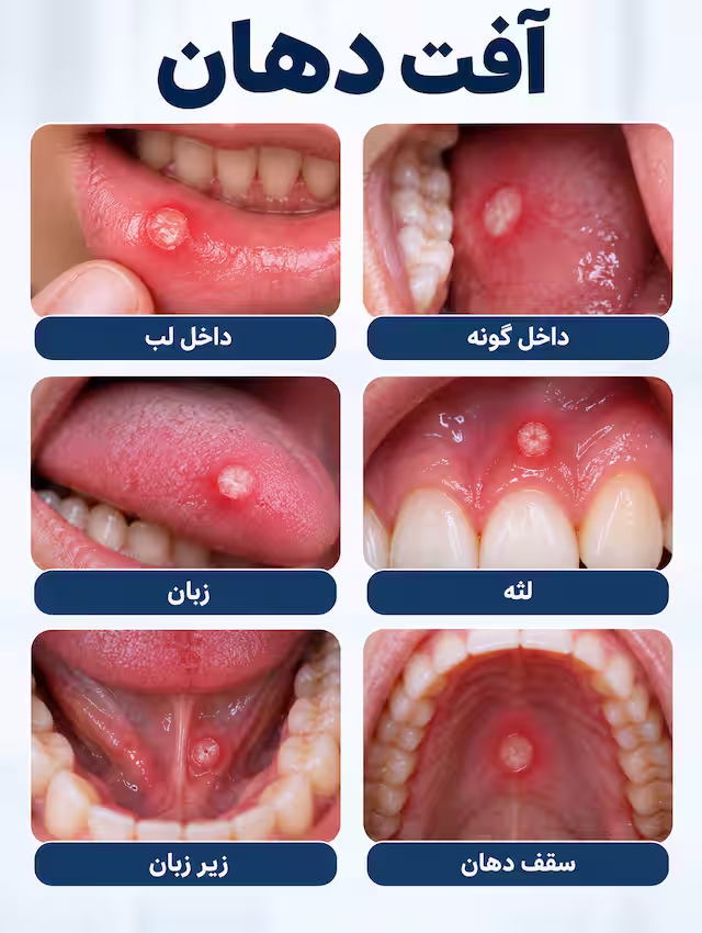 انواع آفت دهان در لب، گونه، زبان، لثه، زیر زبان و سقف دهان