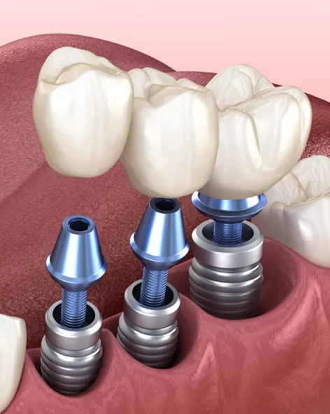 فیکسچر-ایمپلنت-چیست