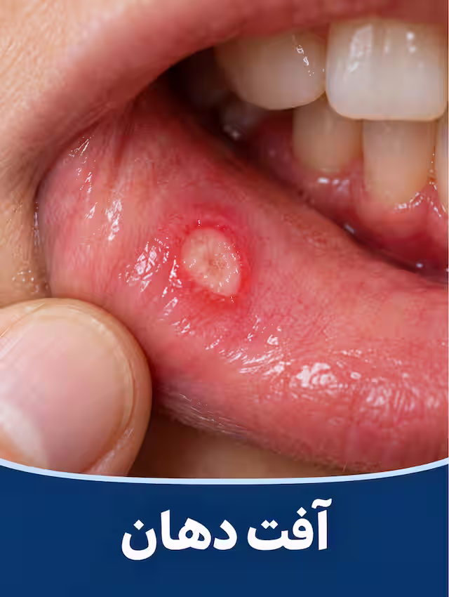 آفت دهان از بیماری‌ها و ضایعات شایع دهانی