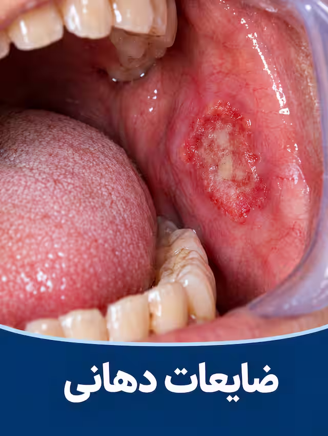ضایعات دهانی روی مخاط داخل دهان